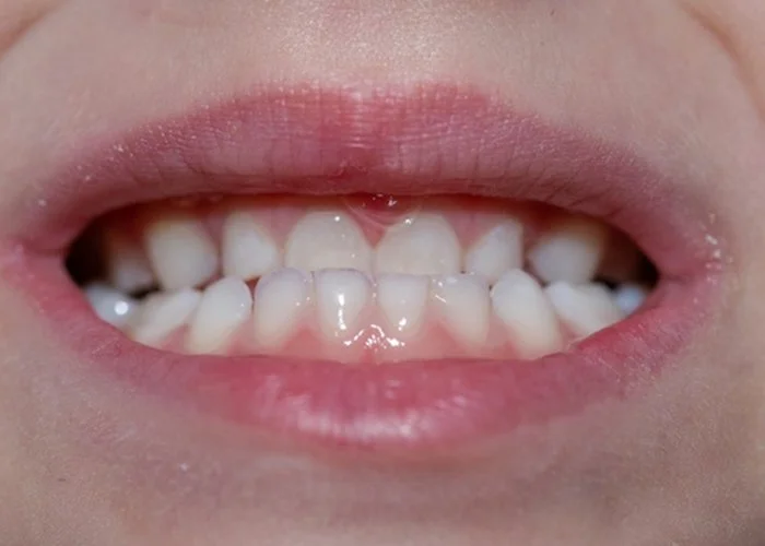 Close-up of a person's open mouth showing teeth and lips.