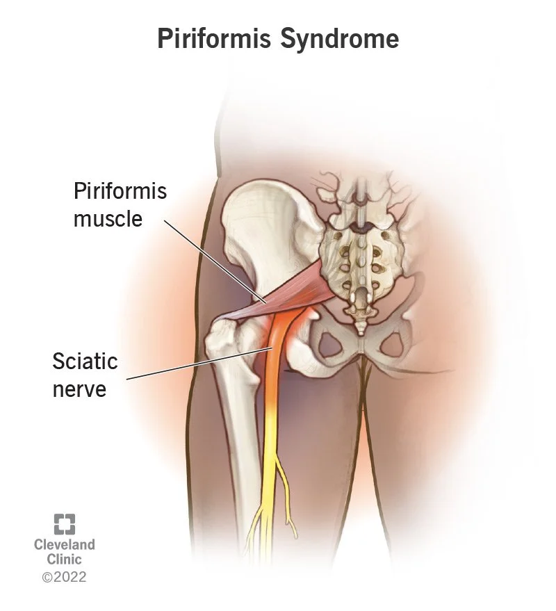 Piriformis syndrooma
