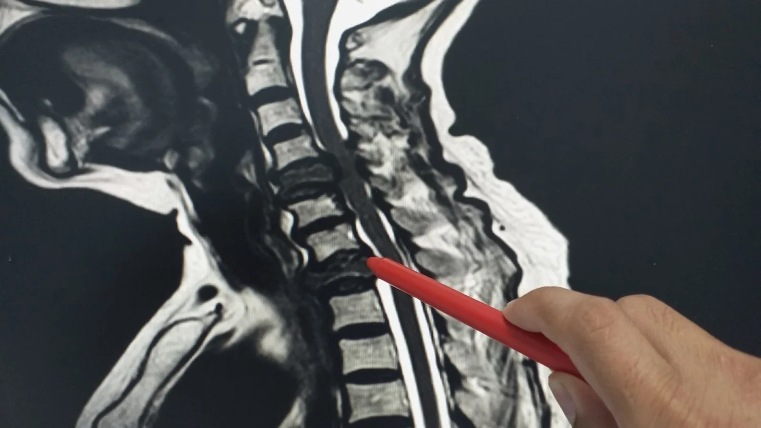 Will A Cervical Mri Show Cancer