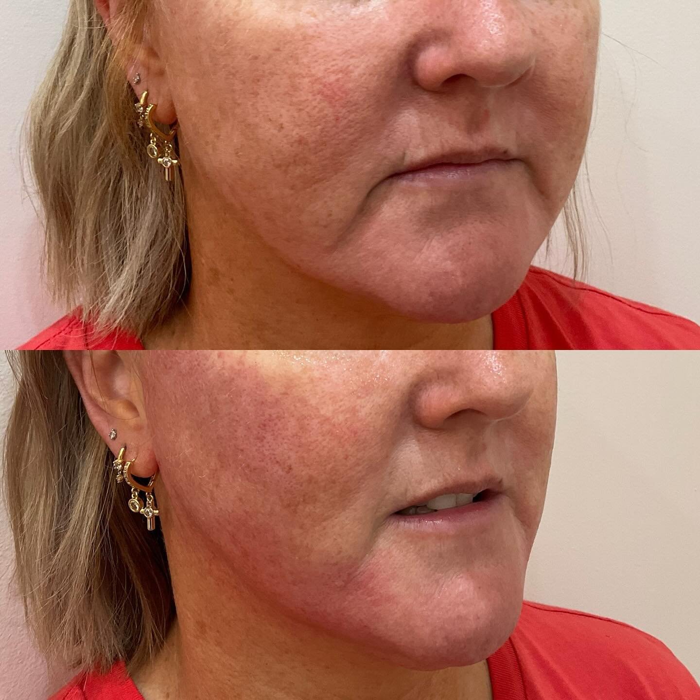 Thermage FLX Obsession!
We&rsquo;re loving the mini-results for our client today, and we can&rsquo;t wait to see how incredible she&rsquo;ll look and feel in six months when the full results come through!

You&rsquo;ve kept us so busy with Thermage t