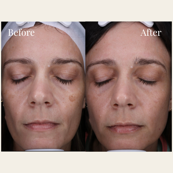 Side-by-side comparison of a woman's face showing skin improvement; the left labeled 'Before' with visible blemishes and uneven skin tone, and the right labeled 'After' with clearer and smoother skin.