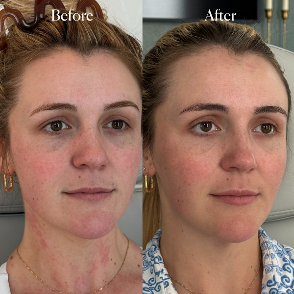Side-by-side comparison of a woman showing skin improvement; before with redness and irritation, after with clearer skin.