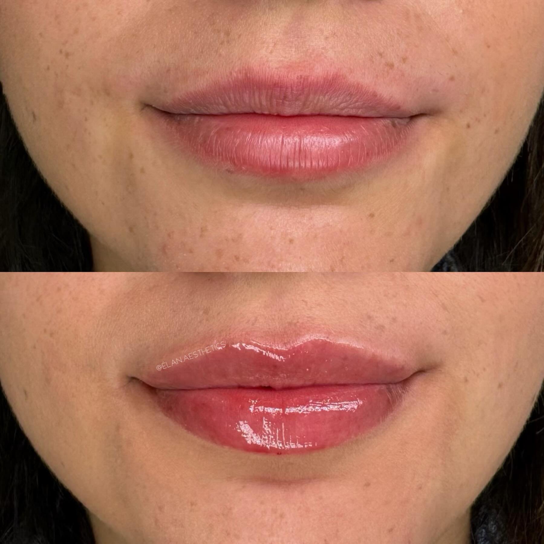 Loving this &ldquo;your lips but better&rdquo; enhancement by @injectorlisa 

Treatment provider:
Lisa Prevatt, MSN, APRN-BC
@injectorlisa

#resultsbyelan ✨

For booking: Call or text (813) 440-8743 or conveniently shop our online store to purchase y