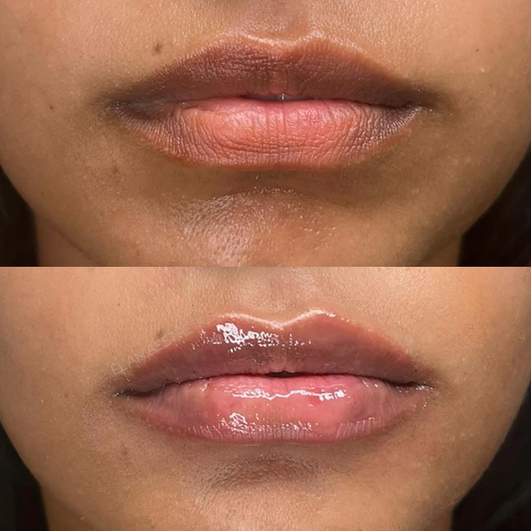 When our client asks for a hydrated, natural-looking lip and @michelletheinjector delivers 👏🏼 Loving this subtle enhancement!

Treatment provider:
Michelle Chapman, APRN
@michelletheinjector

#resultsbyelan ✨

For booking: Call or text (813) 440-87