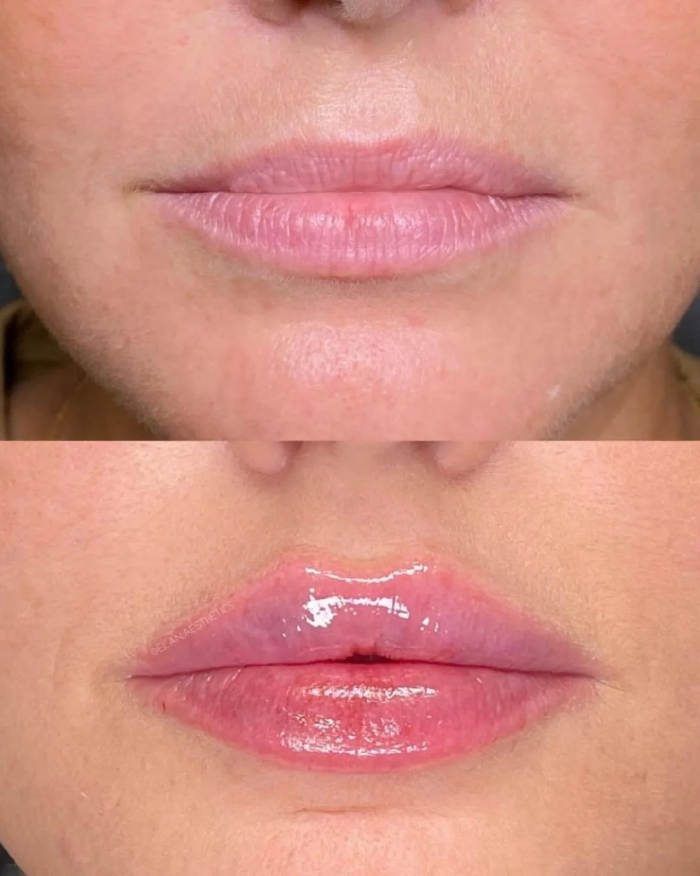 &ldquo;I couldn&rsquo;t be happier with my experience, and I truly feel more beautiful than ever! I came to Lindsey for my first ever lip filler treatment, and she has completely transformed not only my appearance but also my confidence.

The results