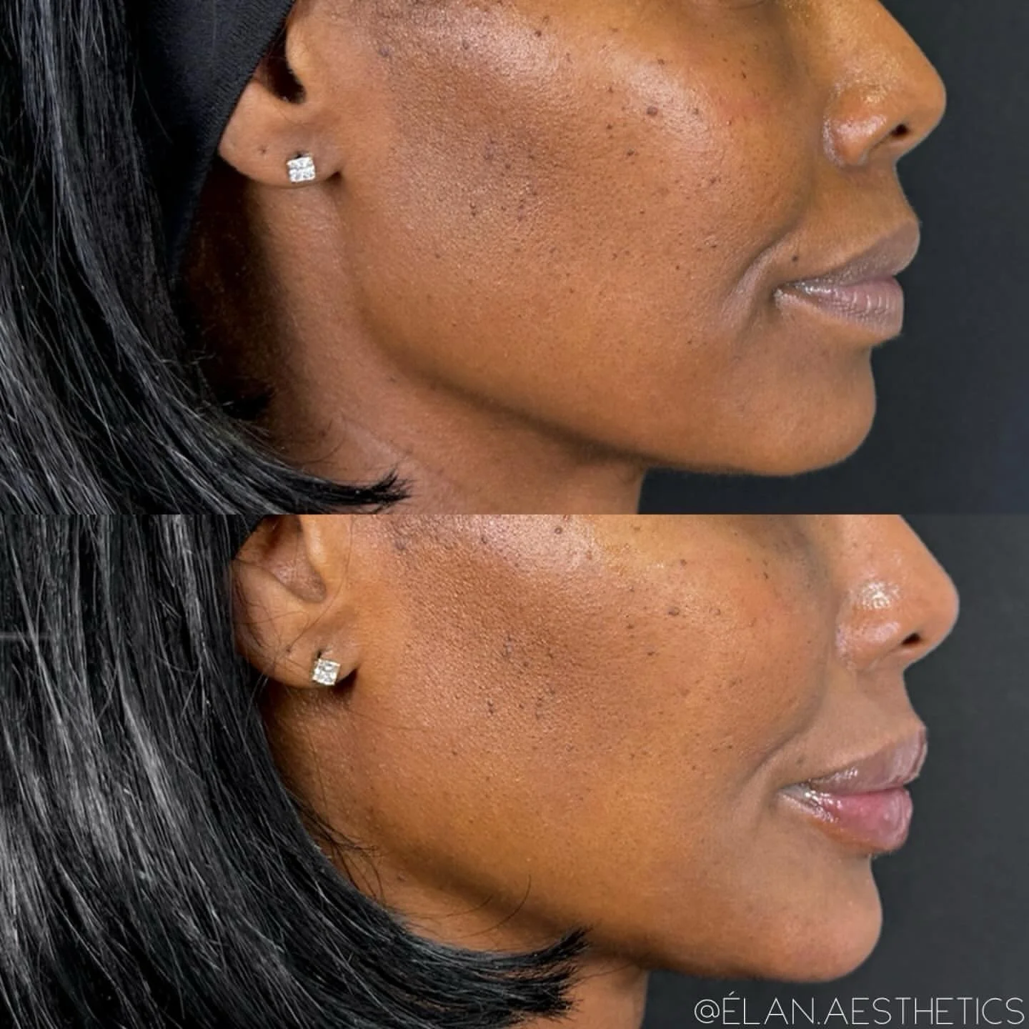 Hydration for the lips and a touch of chin &mdash; sometimes that&rsquo;s all it takes!

Treatment provider:
Zaida Parra, APRN, FNP-C
@injector_zaida

#resultsbyelan ✨

For booking: Call or text (813) 440-8743 or conveniently shop our online store to