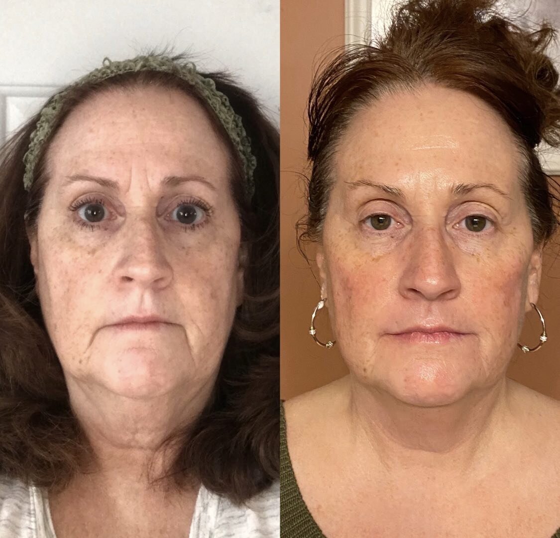 LOVE LOVE LOVE when patients send me their before and after photos. This lovely lady wanted to take baby steps. Her treatment plan will continue in August. ❤️