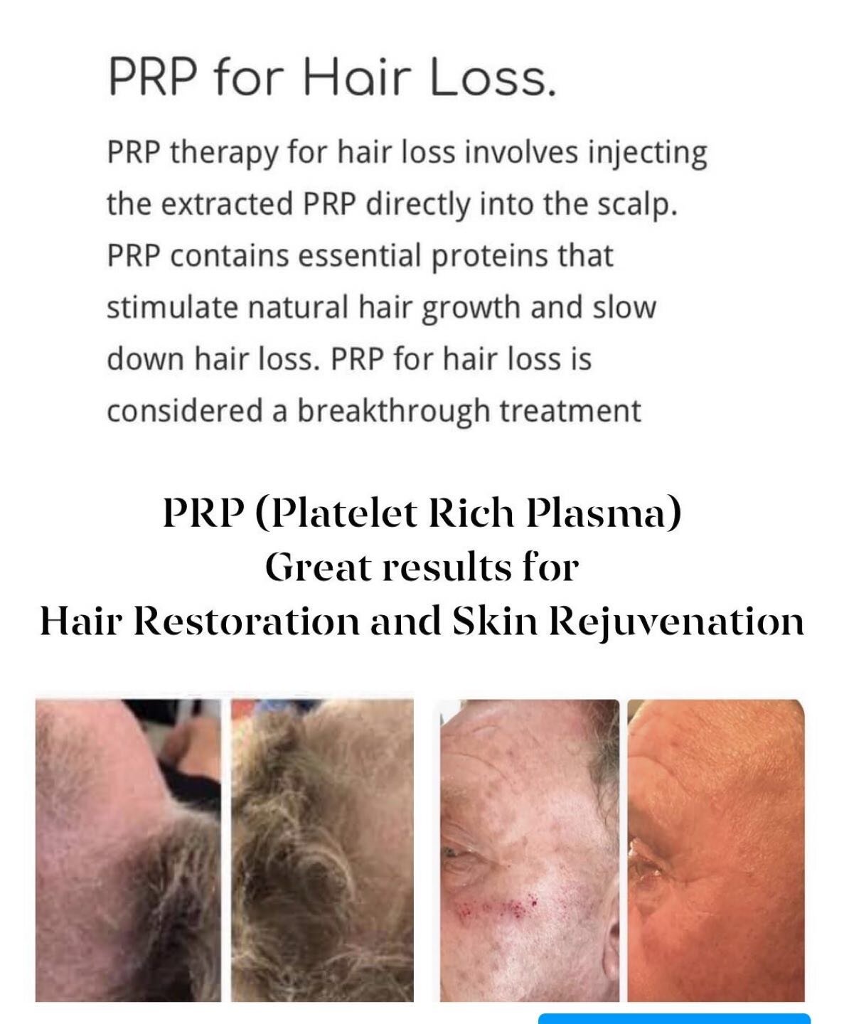 PRP for hair loss!  Amazing results!