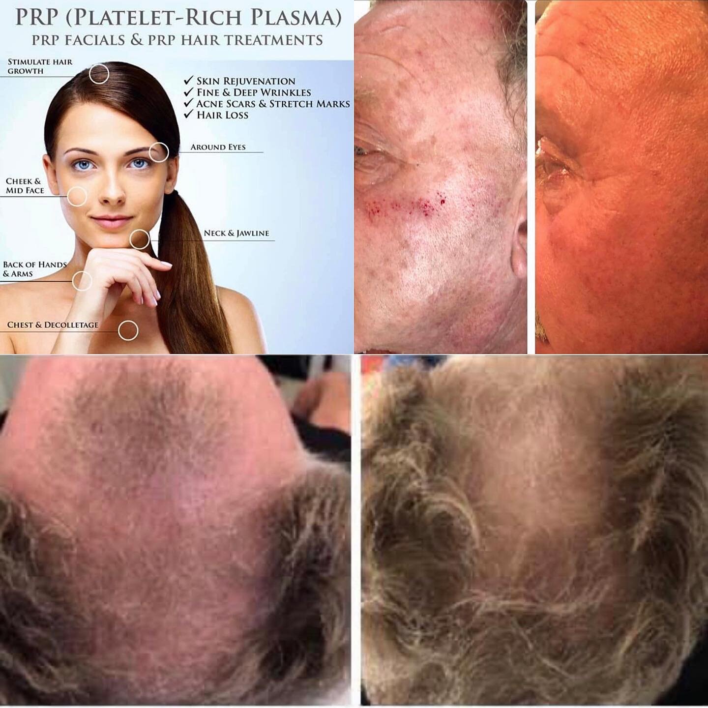 This is a 75 year old gentleman. He was a boxer in his youth. Notice how his coloring returned to his face just one week post treatment.  The before and after of his hair restoration photos are taken 28 days apart.  Platelet rich plasma (PRP)  How ma