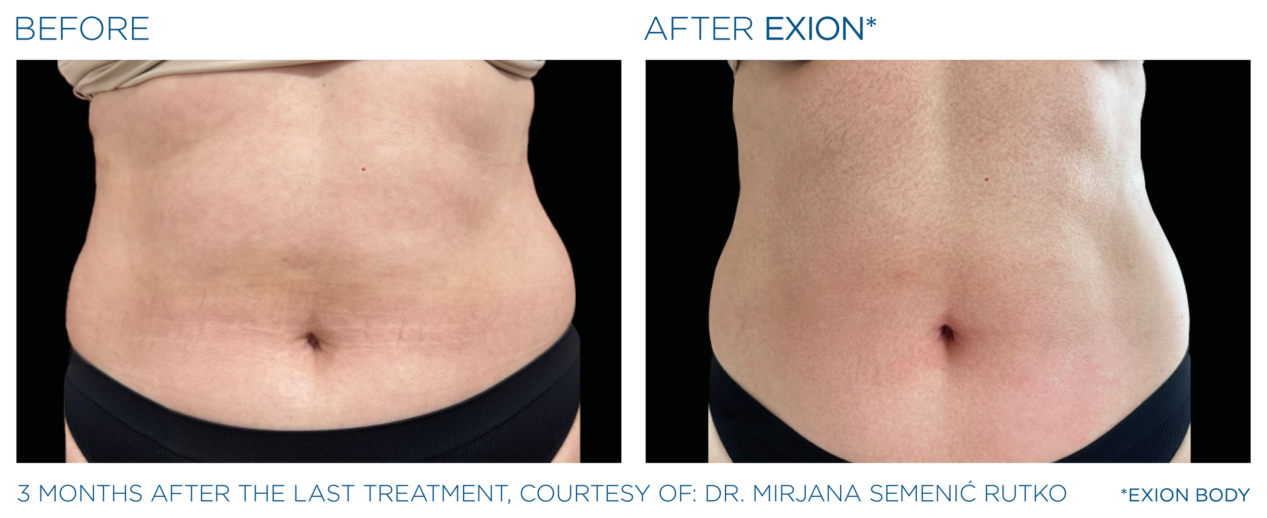 Exion_PIC_Ba-card-abdomen-female-081_Body_EN100.png