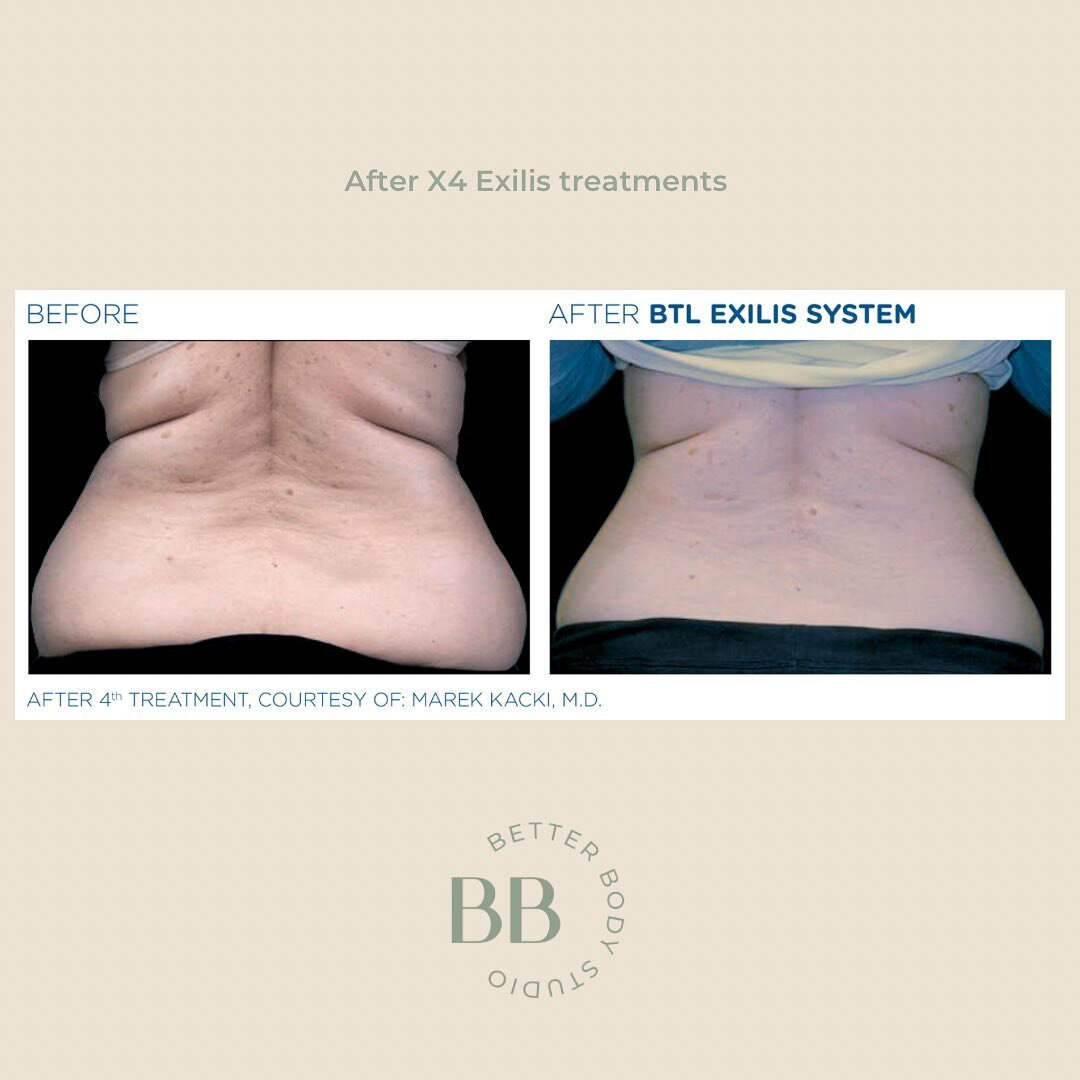 How great are these results to treat our stubborn back areas. 

The Exilis Ultra 360 is a great option for reducing unwanted back fat. The treatment is non-invasive, meaning there is no surgery involved, and it can be done in a relatively short amoun