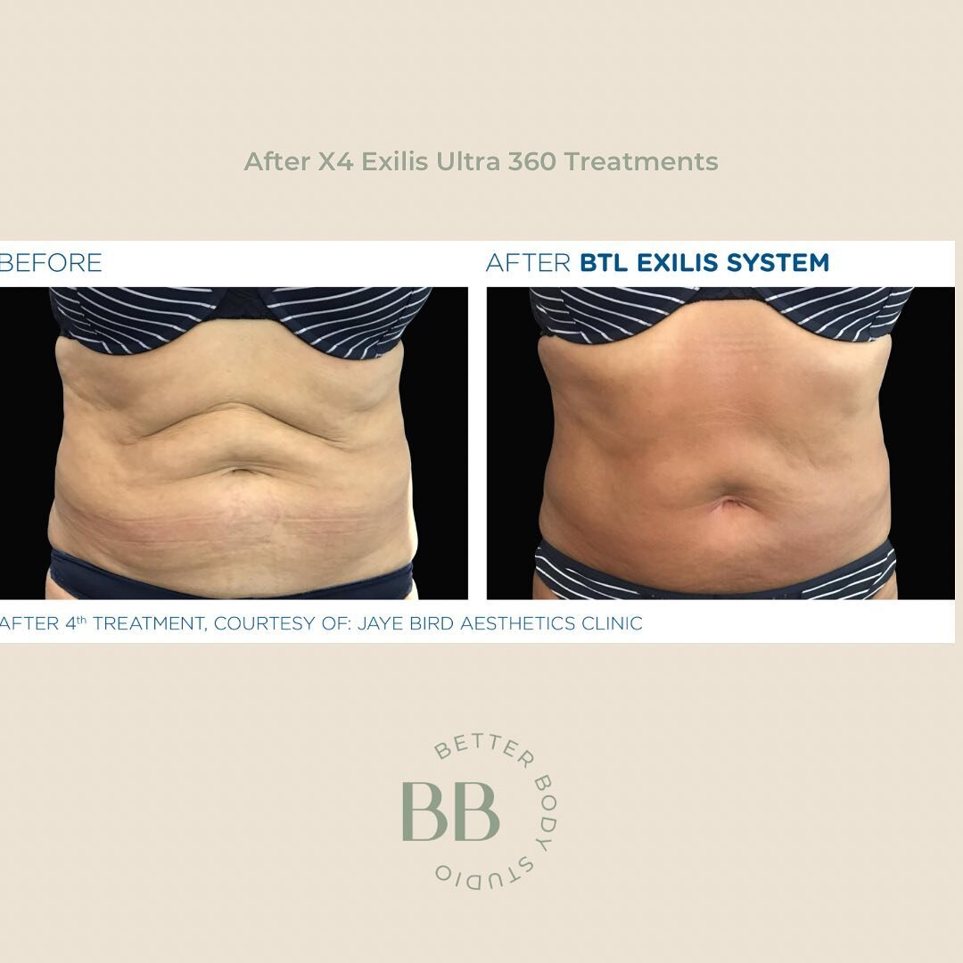 Before and After 🙌🏻 

The Exilis Ultra 360 is often used on the stomach/ abdomen area to tighten and tone the skin. 

This treatment heats the skin and underlying tissue to stimulate collagen production, which helps tighten and tone the skin. 

#ex
