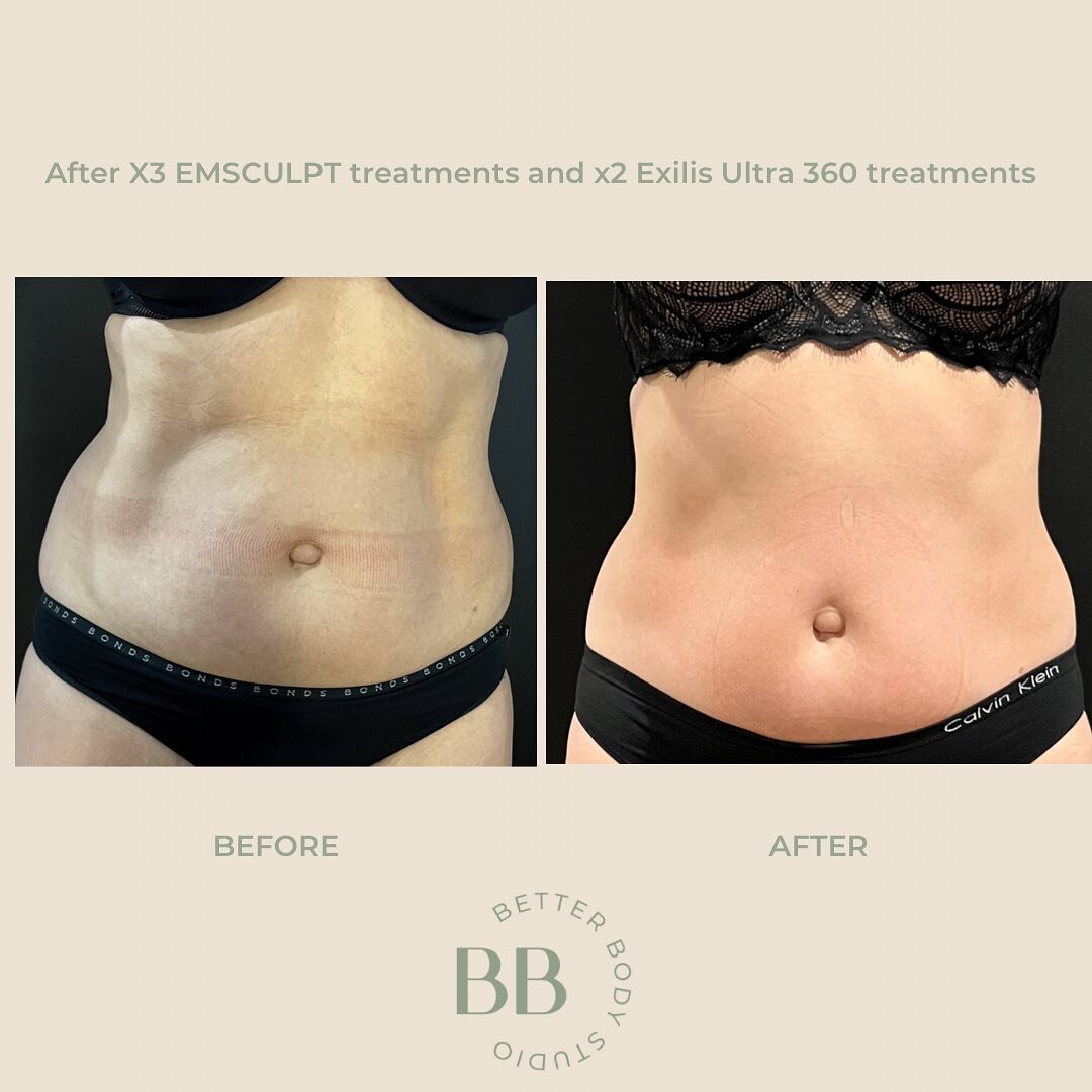 These are results you could look forward to when you combine the Emsculpt and Exilis Ultra 360 treatments to contour your body, burn fat and build muscle.