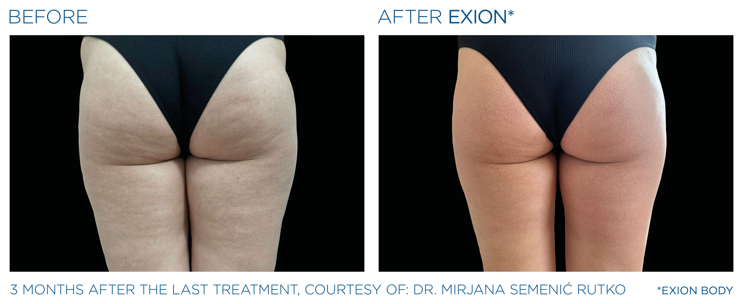 Exion_PIC_Ba-card-buttock-female-082_Body_EN100.png