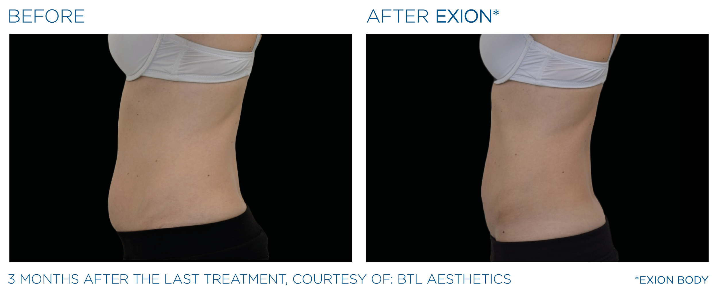 Exion_PIC_Ba-card-lateral-abdomen-female-034_Body_ENUS100.png