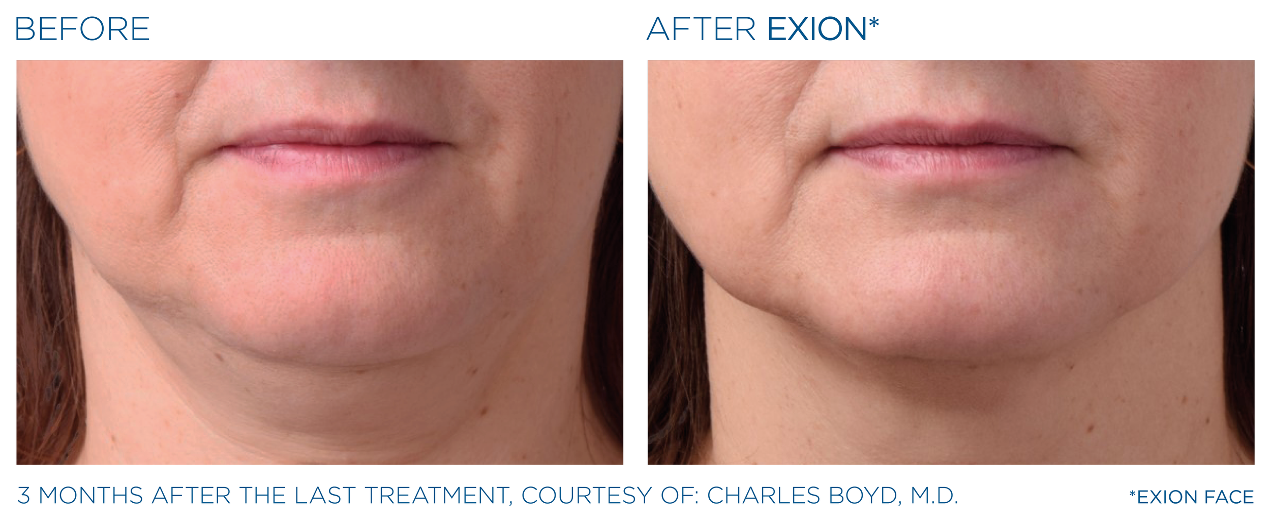 Exion_PIC_Ba-card-neck-female-062_Face_ENUS100.png