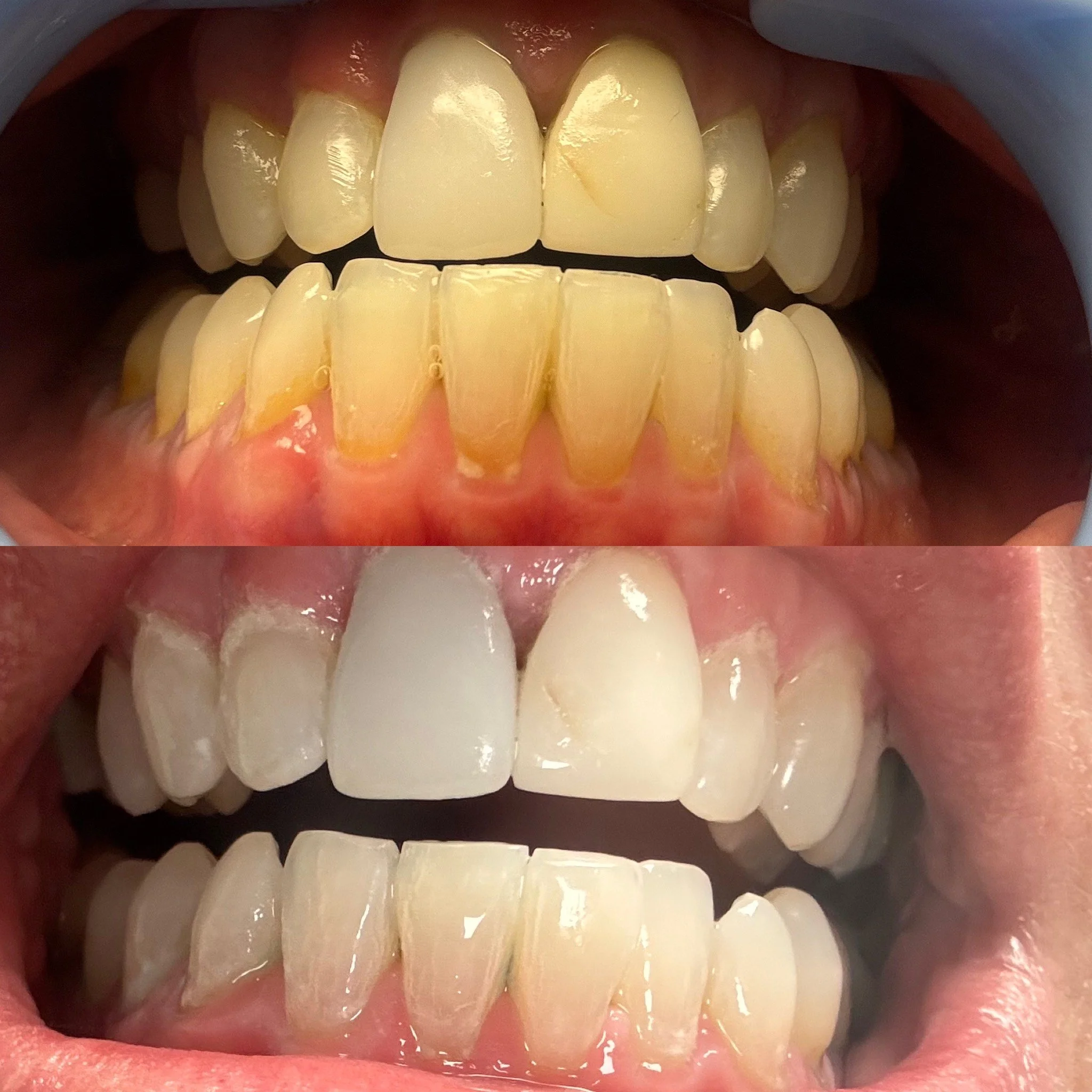 The owners teeth whitening treatment