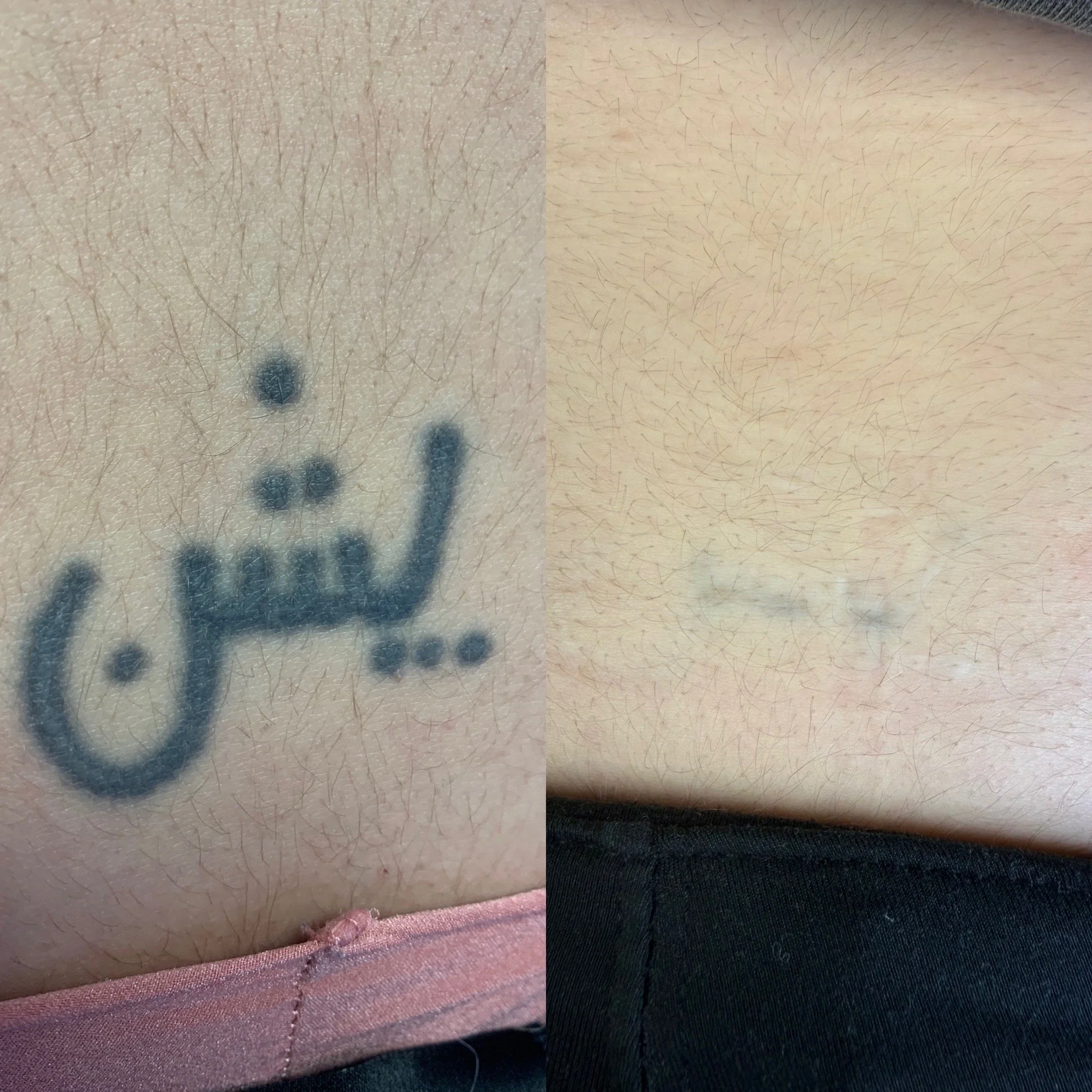 A before and after picture of a lower back tattoo.  5 treatments and it is almost gone.