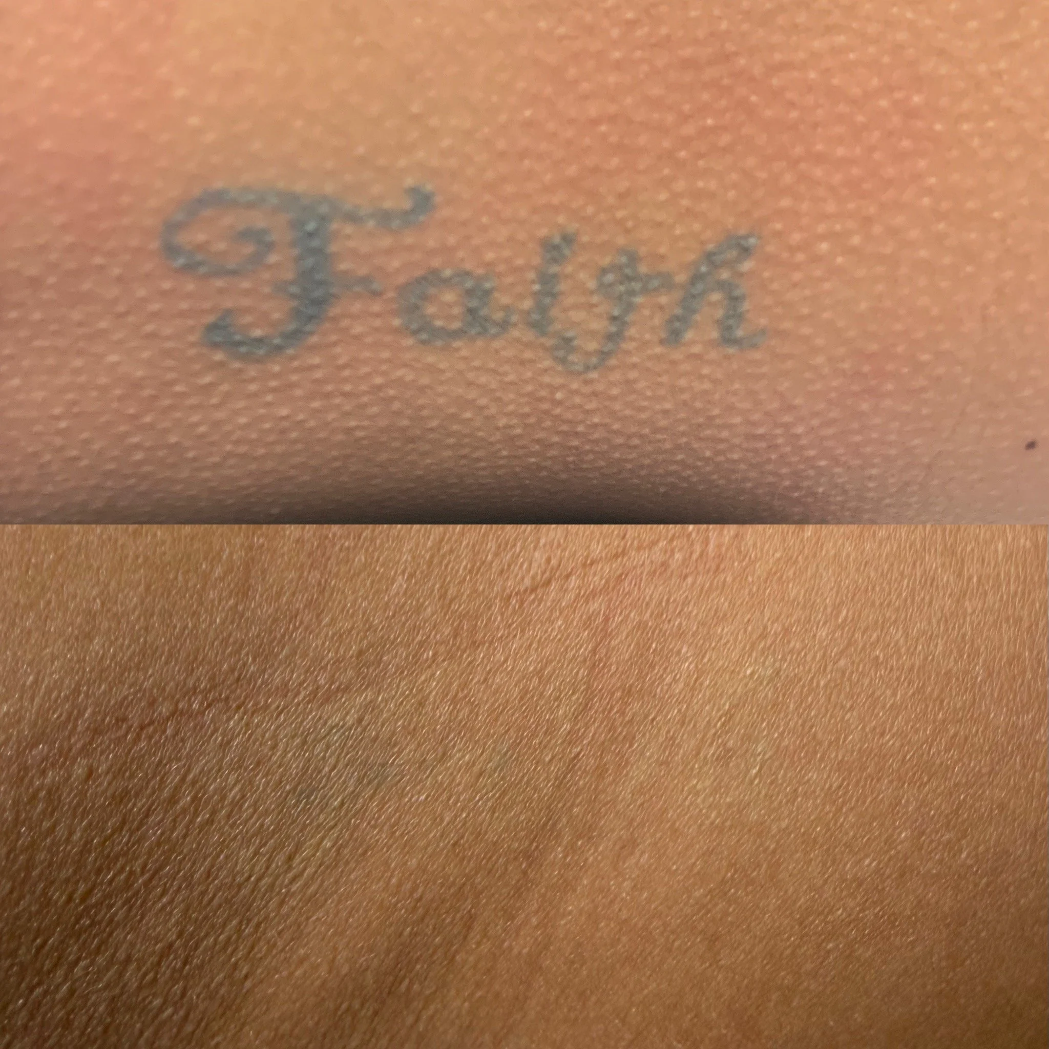 A one treatment removal of a tattoo that says Faith on the side.  