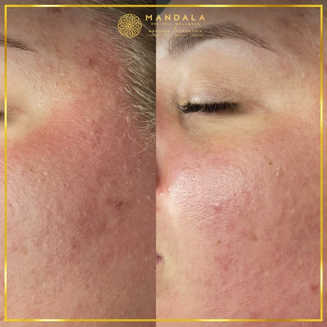 Facial treatment before and after results showing refreshed, hydrated and glowing-looking skin at Mandala Aesthetics in Preston, Melbourne.