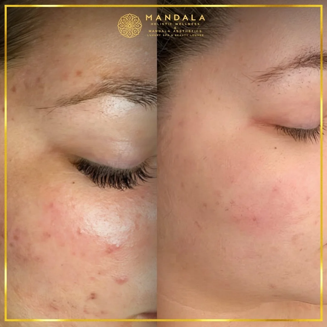 Facial treatment before and after results showing refreshed, hydrated and glowing-looking skin at Mandala Aesthetics in Preston, Melbourne.