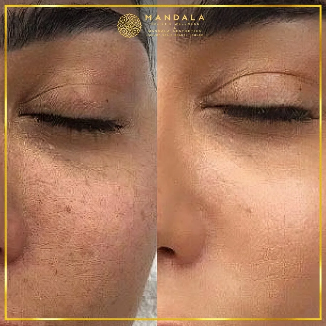 WhiteLab Spot Melanin Removal before and after results showing the appearance of age spots, sun spots , freckles, melasma, pigmentation at Mandala Aesthetics in Preston, Melbourne.