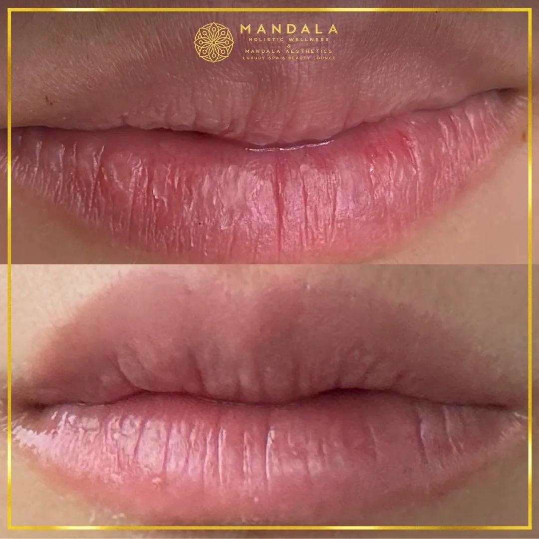 RomaPink Lip Treatment before and after results showing a more even, hydrated lips and naturally pink-looking lip tone at Mandala Aesthetics in Preston, Melbourne.