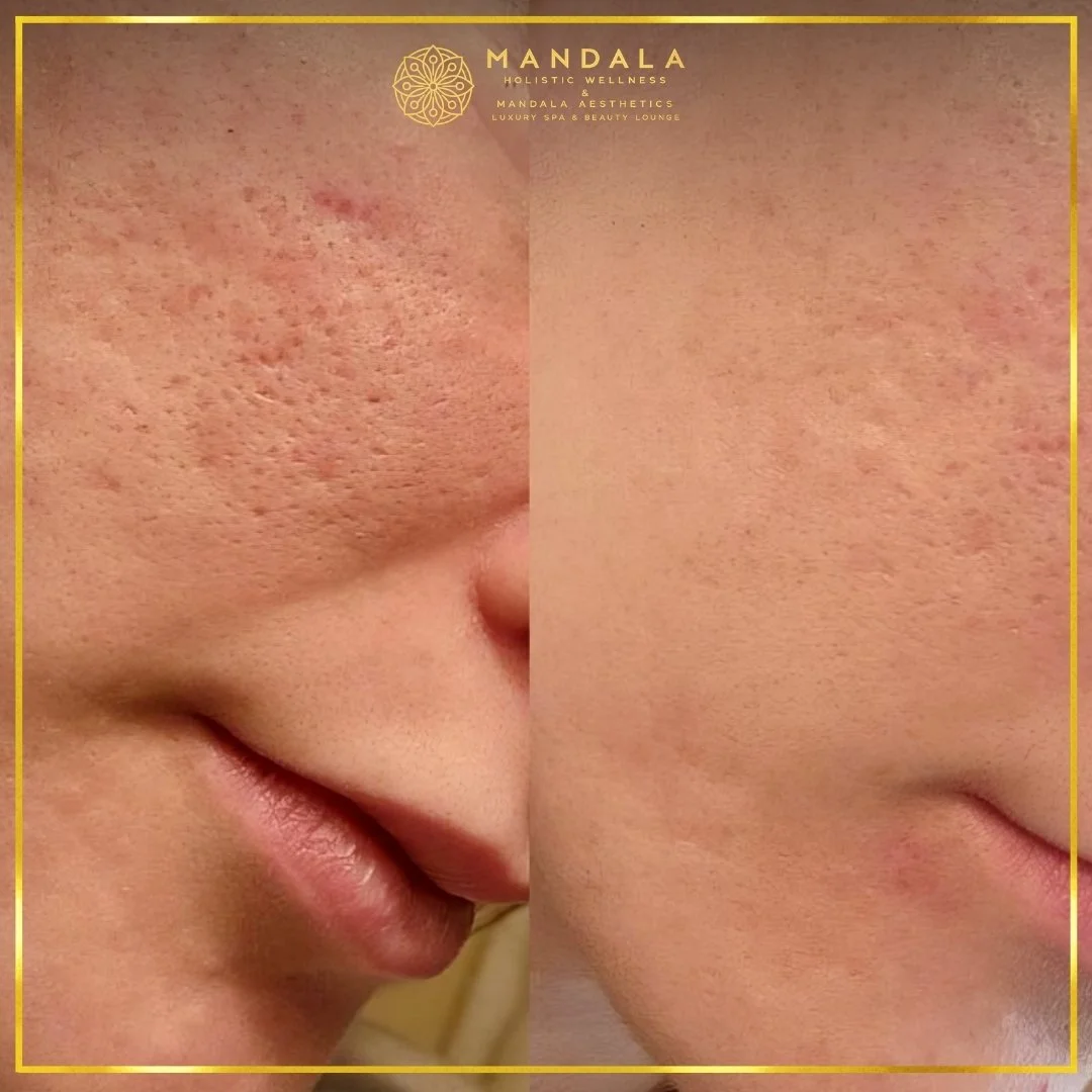RF Microneedling before and after results showing improved-looking skin texture  and acne scars at Mandala Aesthetics in Preston, Melbourne.