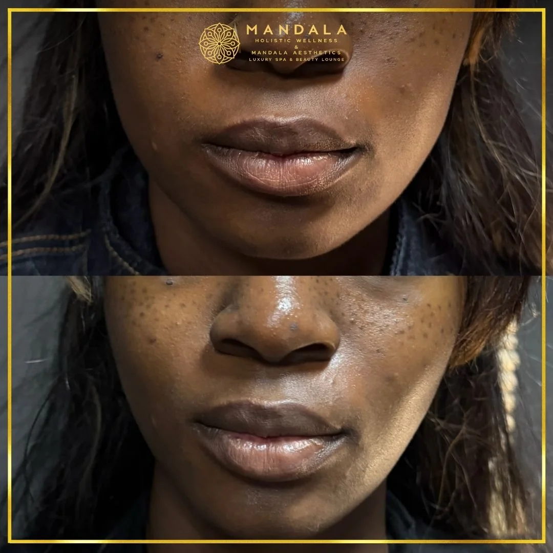 HIFU before and after results showing the lower face, chin and jawline at Mandala Aesthetics in Preston, Melbourne.