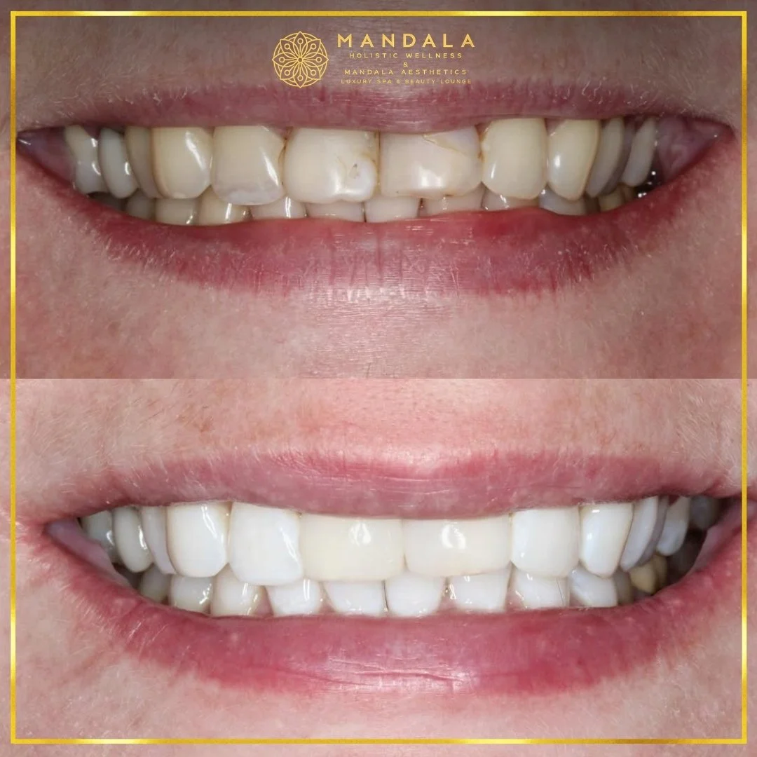 Teeth whitening before and after results showing a visibly white teeth,  brighter-looking smile at Mandala Aesthetics in Preston, Melbourne.