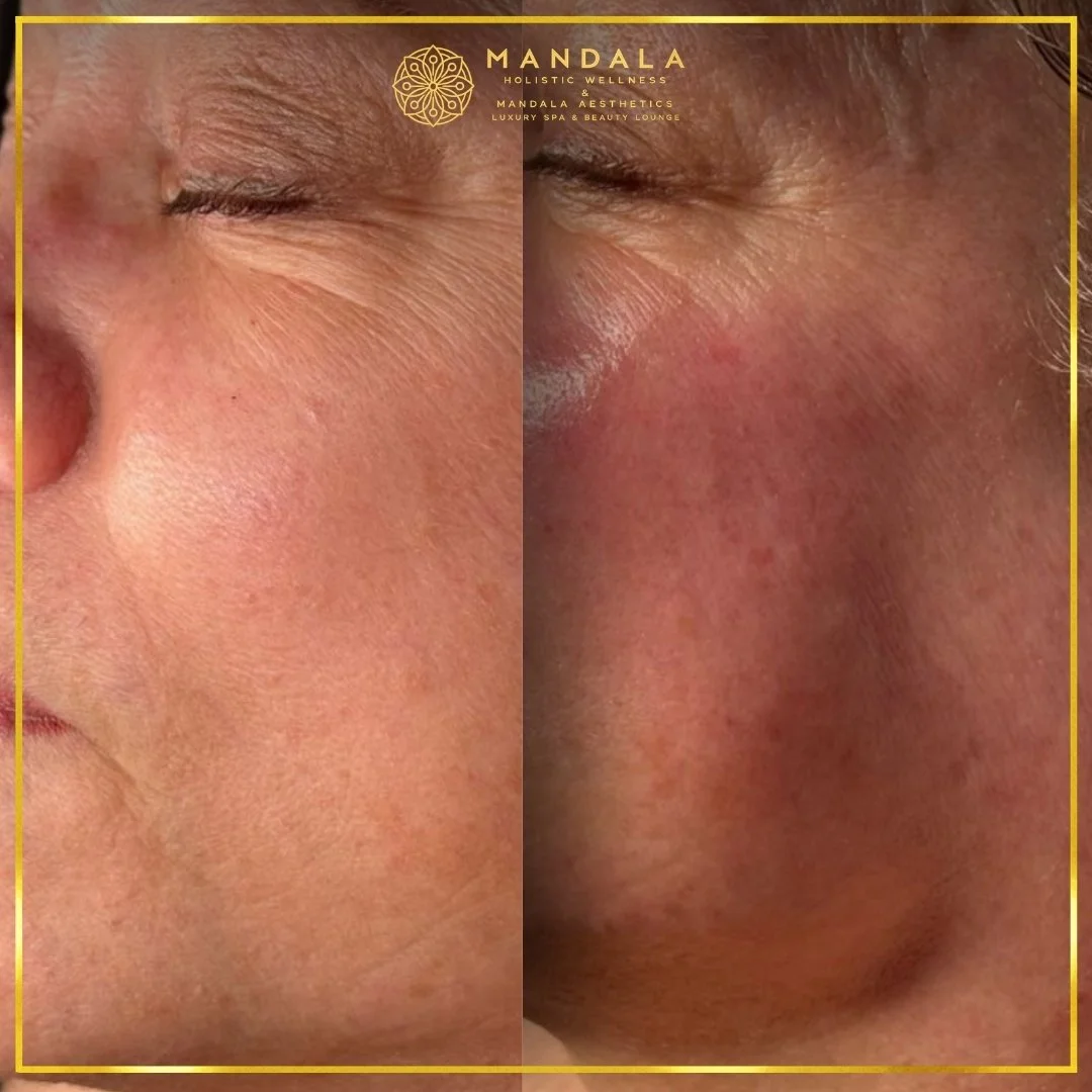 RF Microneedling before and after results showing improved-looking skin texture  and acne scars at Mandala Aesthetics in Preston, Melbourne.