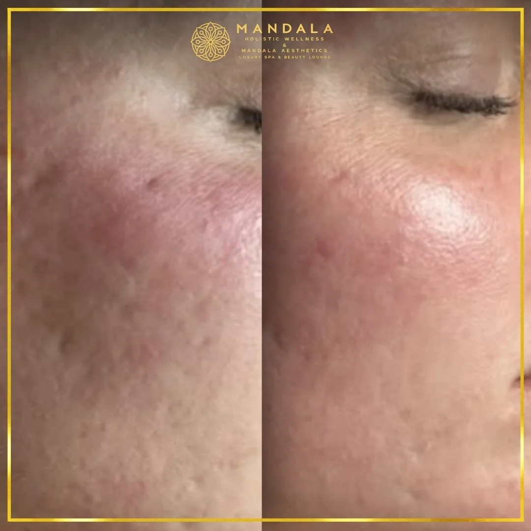 RF Microneedling before and after results showing improved-looking skin texture  and acne scars at Mandala Aesthetics in Preston, Melbourne.