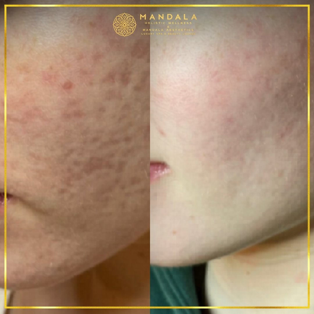RF Microneedling before and after results showing improved-looking skin texture  and acne scars at Mandala Aesthetics in Preston, Melbourne.
