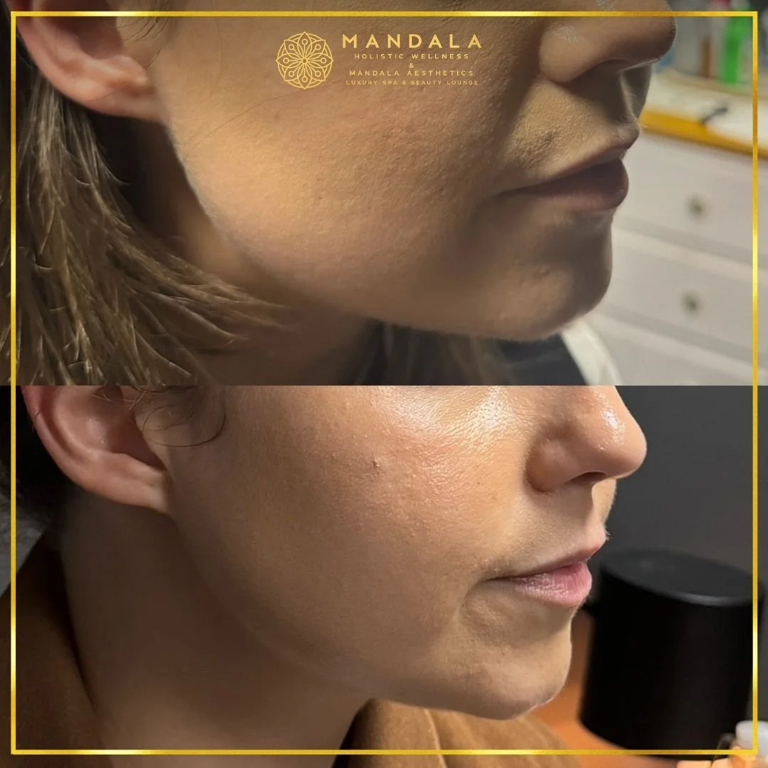 HIFU before and after results showing the lower face, chin and jawline at Mandala Aesthetics in Preston, Melbourne.