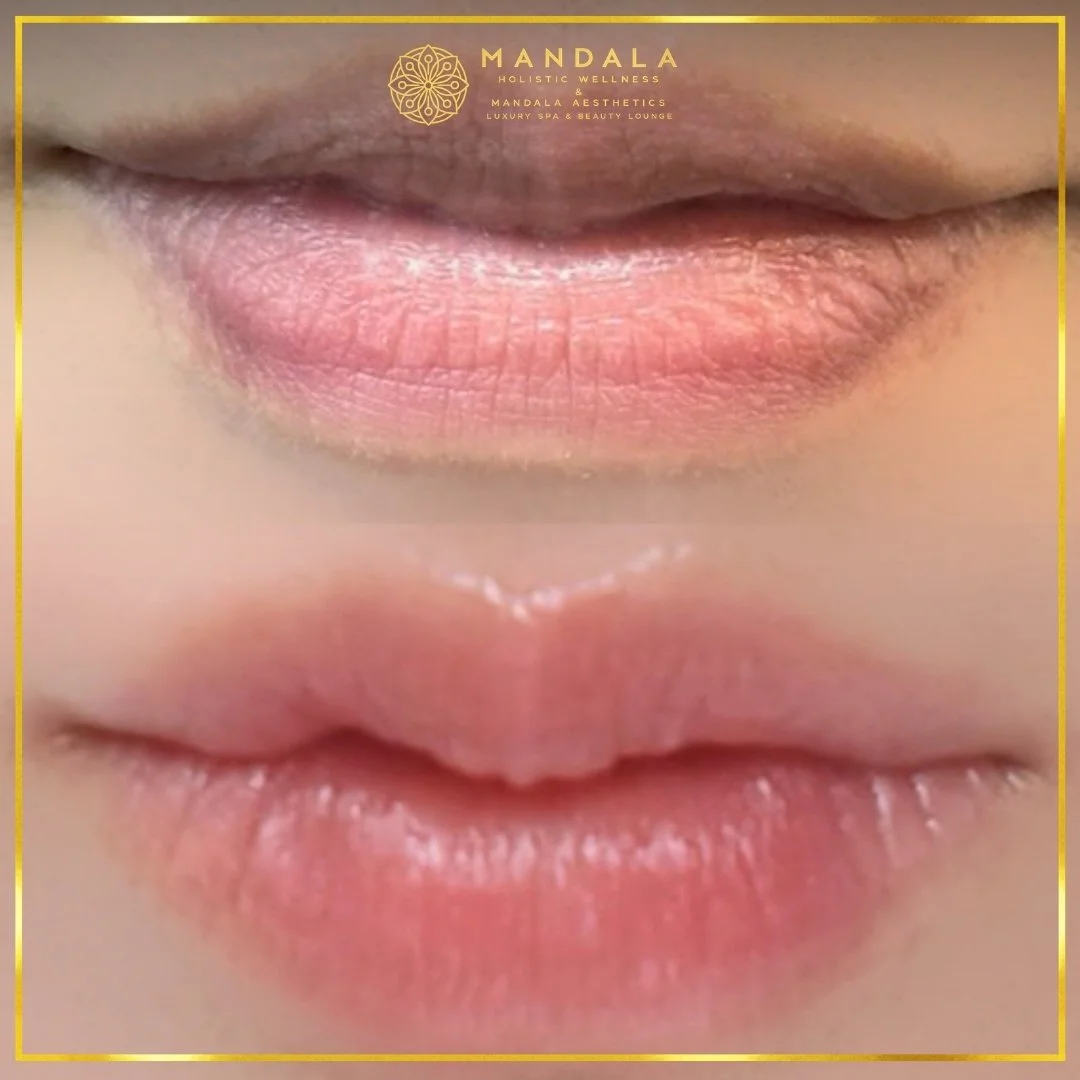 RomaPink Lip Treatment before and after results showing a more even, hydrated lips and naturally pink-looking lip tone at Mandala Aesthetics in Preston, Melbourne.