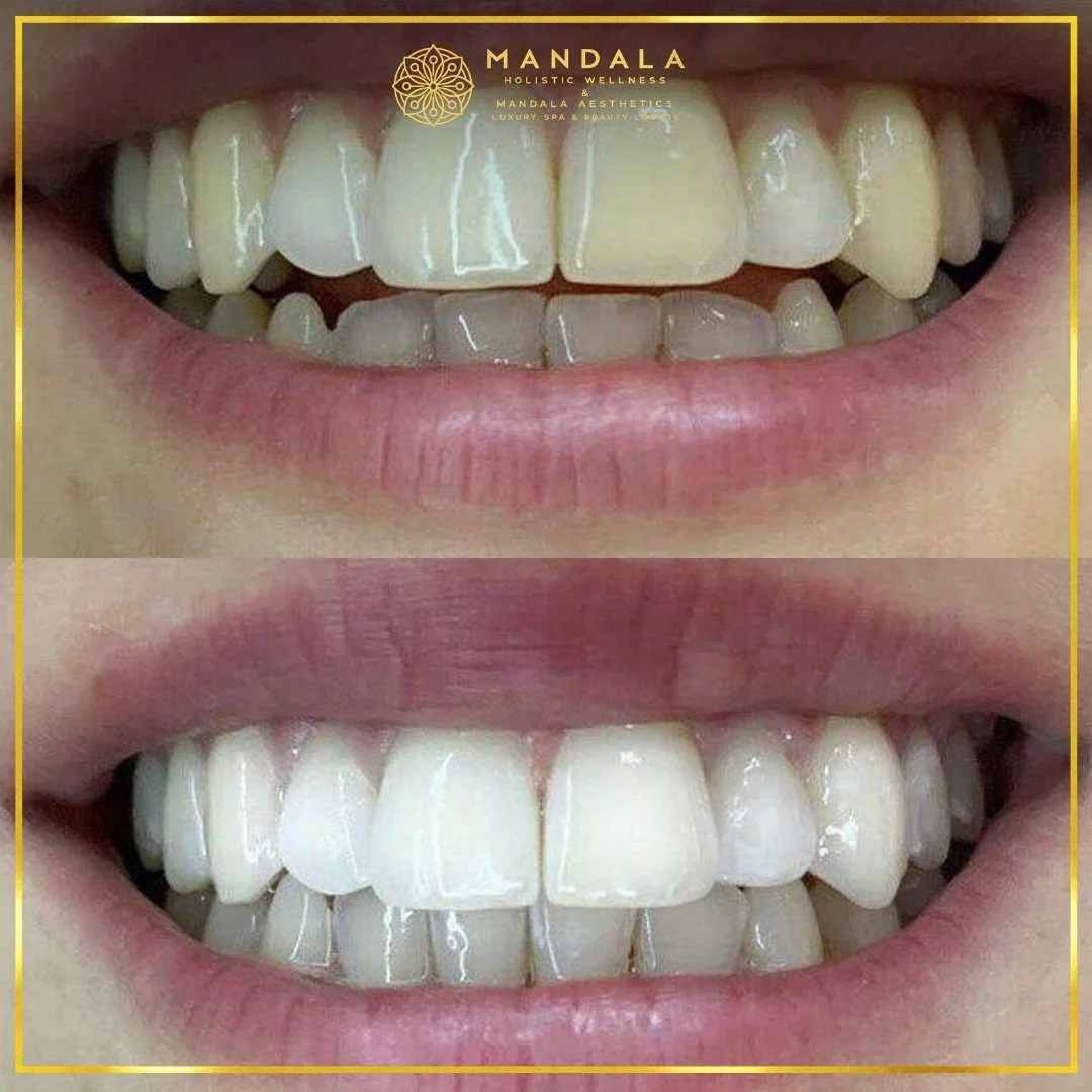 Teeth whitening before and after results showing a visibly white teeth,  brighter-looking smile at Mandala Aesthetics in Preston, Melbourne.
