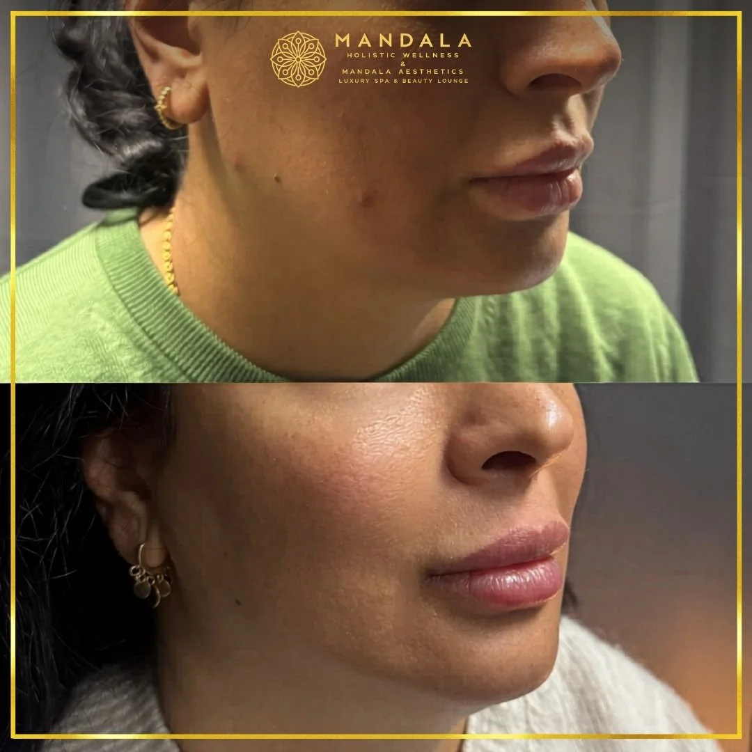 HIFU before and after results showing the lower face, chin and jawline at Mandala Aesthetics in Preston, Melbourne.