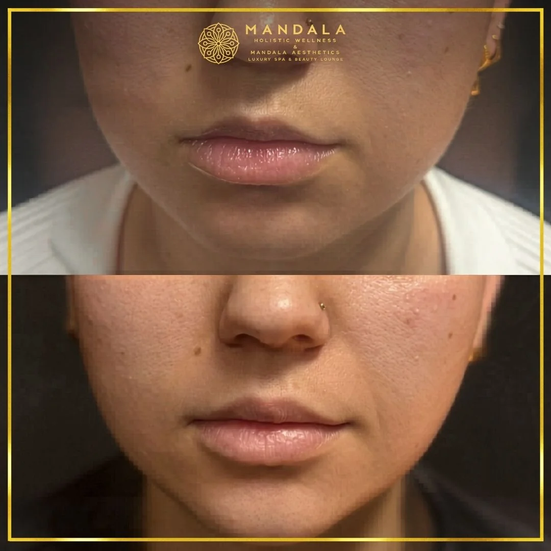 HIFU before and after results showing the lower face, chin and jawline at Mandala Aesthetics in Preston, Melbourne.