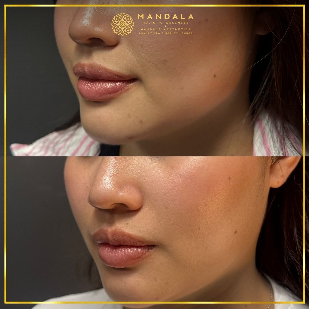HIFU before and after results showing the lower face, chin and jawline at Mandala Aesthetics in Preston, Melbourne.