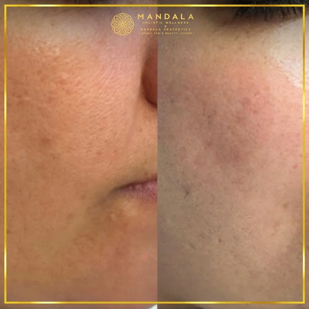 RF Microneedling before and after results showing improved-looking skin texture  and acne scars at Mandala Aesthetics in Preston, Melbourne.
