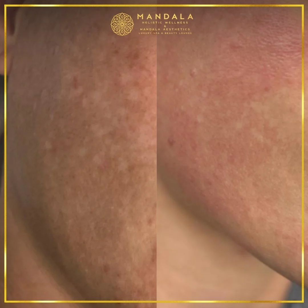 WhiteLab Spot Melanin Removal before and after results showing the appearance of age spots, sun spots , freckles, melasma, pigmentation at Mandala Aesthetics in Preston, Melbourne.