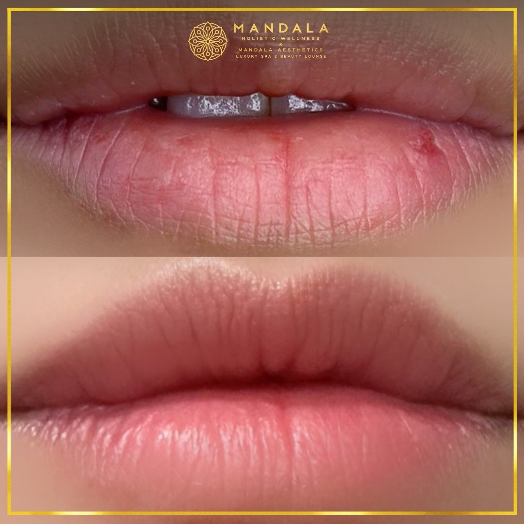 RomaPink Lip Treatment before and after results showing a more even, hydrated lips and naturally pink-looking lip tone at Mandala Aesthetics in Preston, Melbourne.