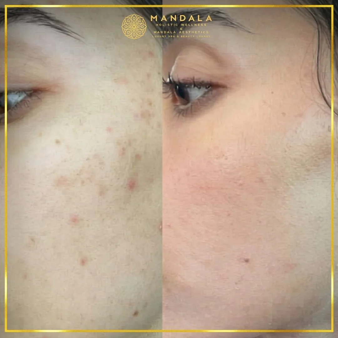 Facial treatment before and after results showing refreshed, hydrated and glowing-looking skin at Mandala Aesthetics in Preston, Melbourne.