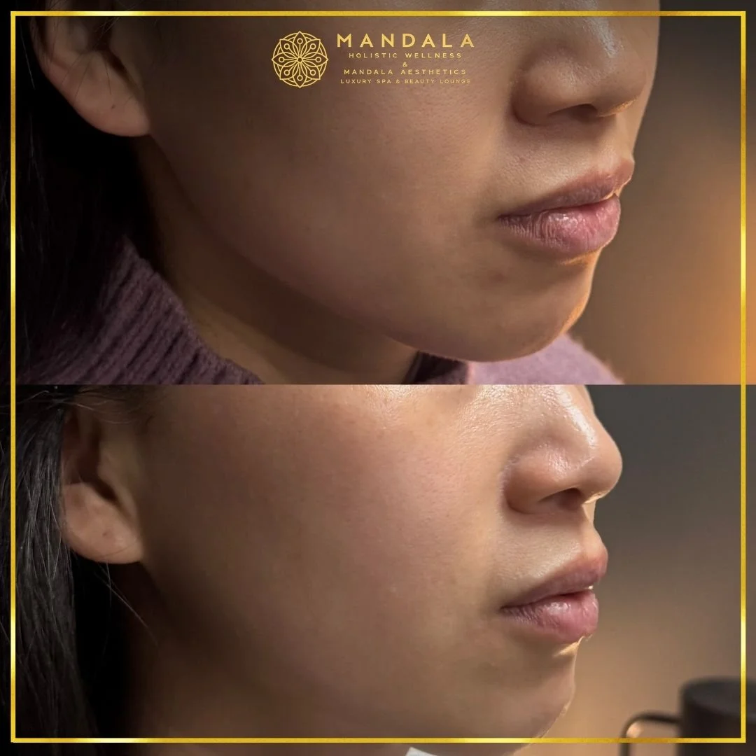 HIFU before and after results showing the lower face, chin and jawline at Mandala Aesthetics in Preston, Melbourne.