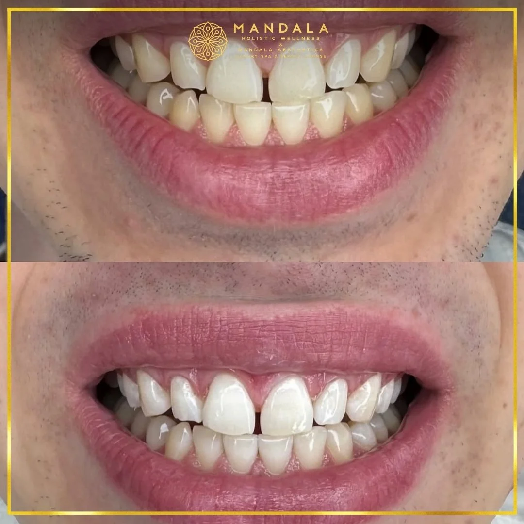 Teeth whitening before and after results showing a visibly white teeth,  brighter-looking smile at Mandala Aesthetics in Preston, Melbourne.