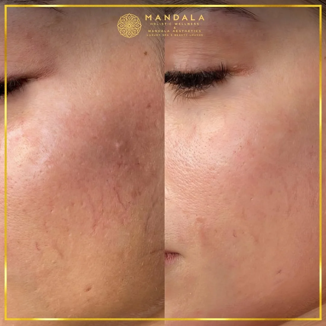Facial treatment before and after results showing refreshed, hydrated and glowing-looking skin at Mandala Aesthetics in Preston, Melbourne.