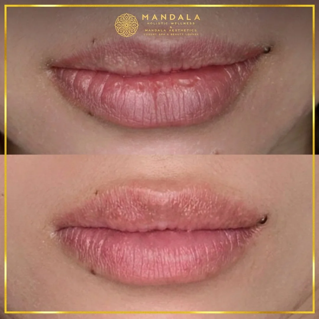 RomaPink Lip Treatment before and after results showing a more even, hydrated lips and naturally pink-looking lip tone at Mandala Aesthetics in Preston, Melbourne.