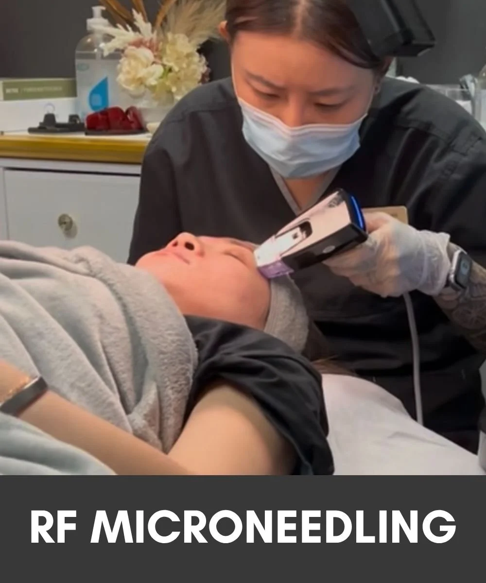 rf microneedling