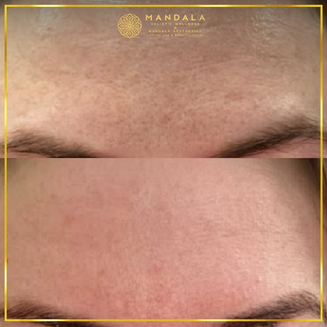 RF Microneedling before and after results showing improved-looking skin texture  and acne scars at Mandala Aesthetics in Preston, Melbourne.