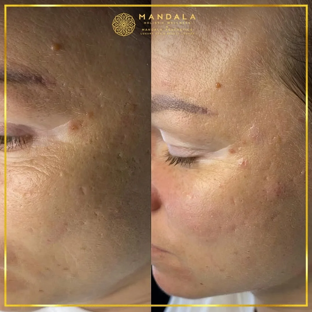 RF Microneedling before and after results showing improved-looking skin texture  and acne scars at Mandala Aesthetics in Preston, Melbourne.